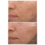 pca-skin-blemish-control-bar-2