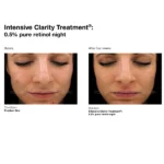 pca-skin-retinol-acne-treatment