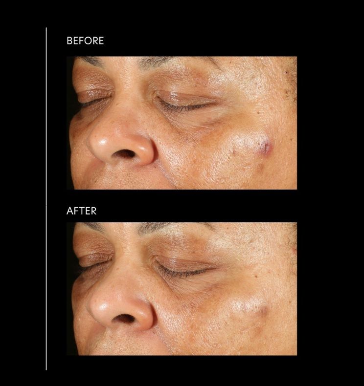 Pigment Gel® Pro - професионален серум при пигментации Pigment Gel® Pro - професионален серум при пигментации